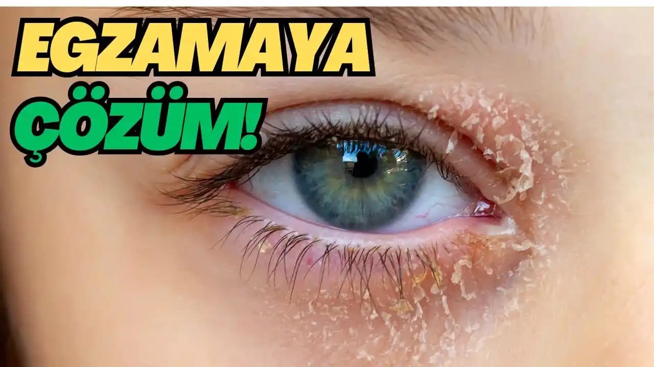 Göz Altında Egzama: Belirtiler, Tedavi Yöntemleri ve Hassas Cilt Bakımı Rehberi