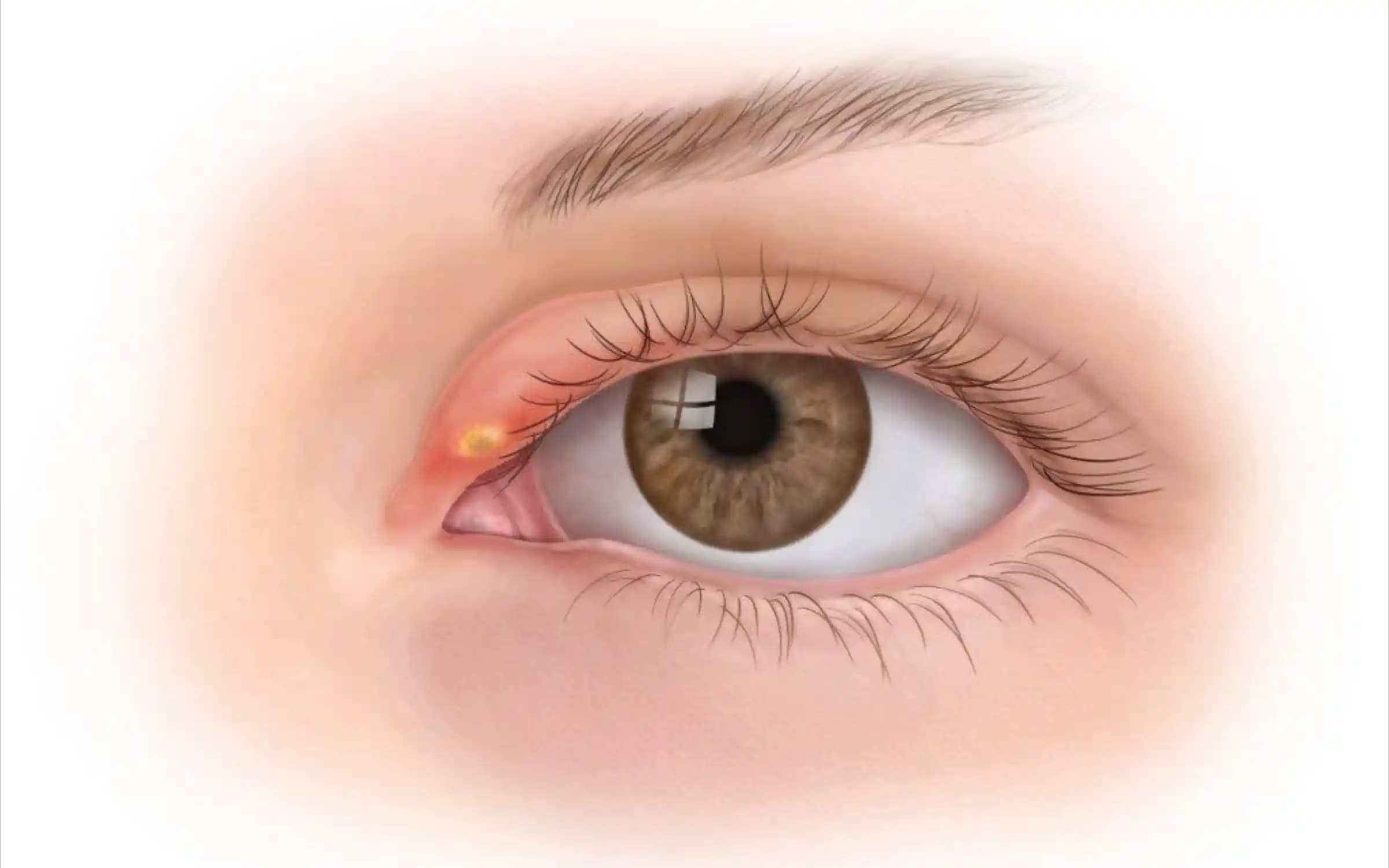 Göz Altında Sivilce Benzeri Şişliklerin Nedenleri ve Doğru Cilt Bakımı Yöntemleri