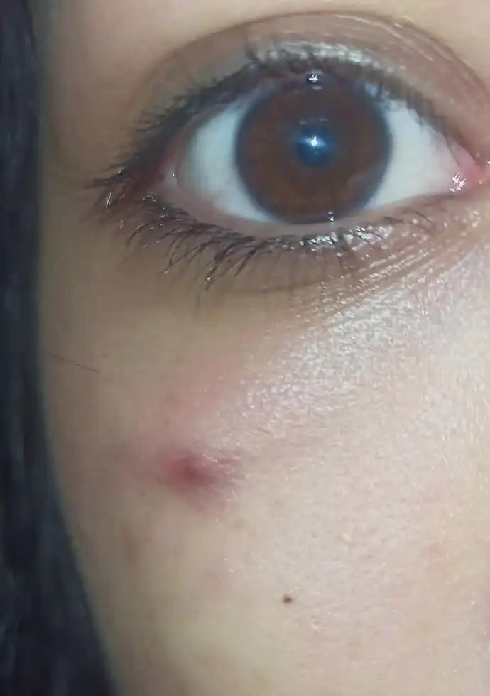 Göz Altında Sivilce: Hassas Ciltte Bilgi Eksikliği ve Bakım Önerileri