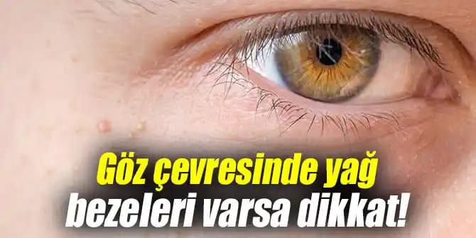 Göz Çevresinde Yağ Bezesi Nedenleri ve Oluşum Süreci Üzerine Kısa Analiz