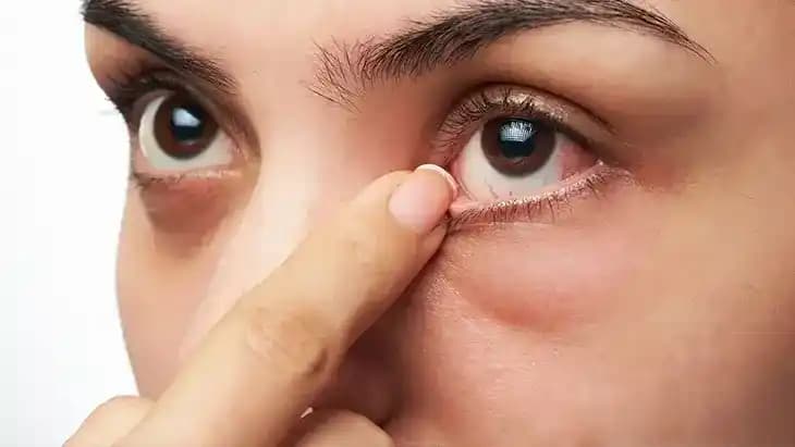 Göz Etrafında Yağ Bezesi Nedenleri ve Tedavi Yaklaşımları Hakkında Bilgi