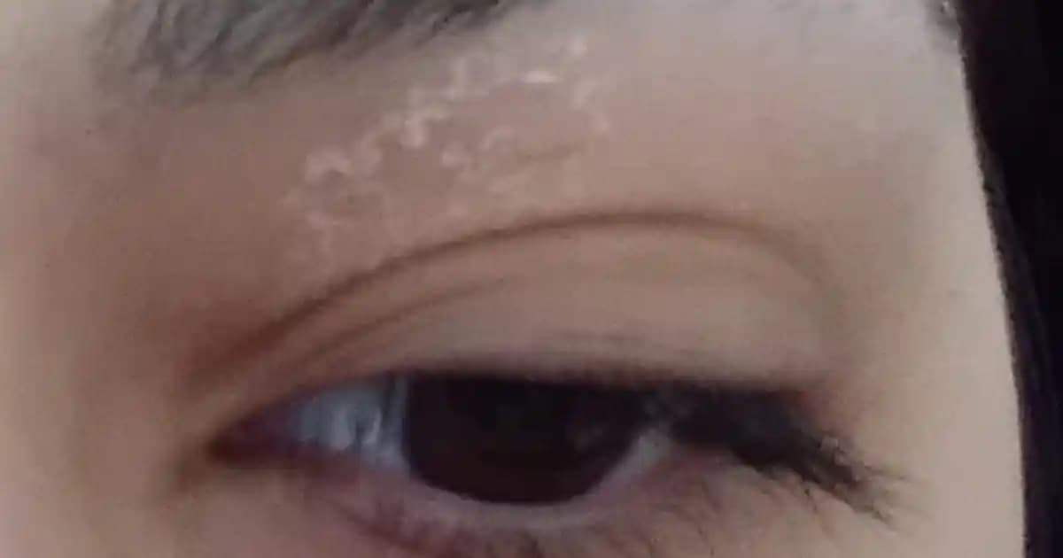 Göz Kapağında Kuruluk: Erken Müdahale ve Etkili Bakım Yöntemleri