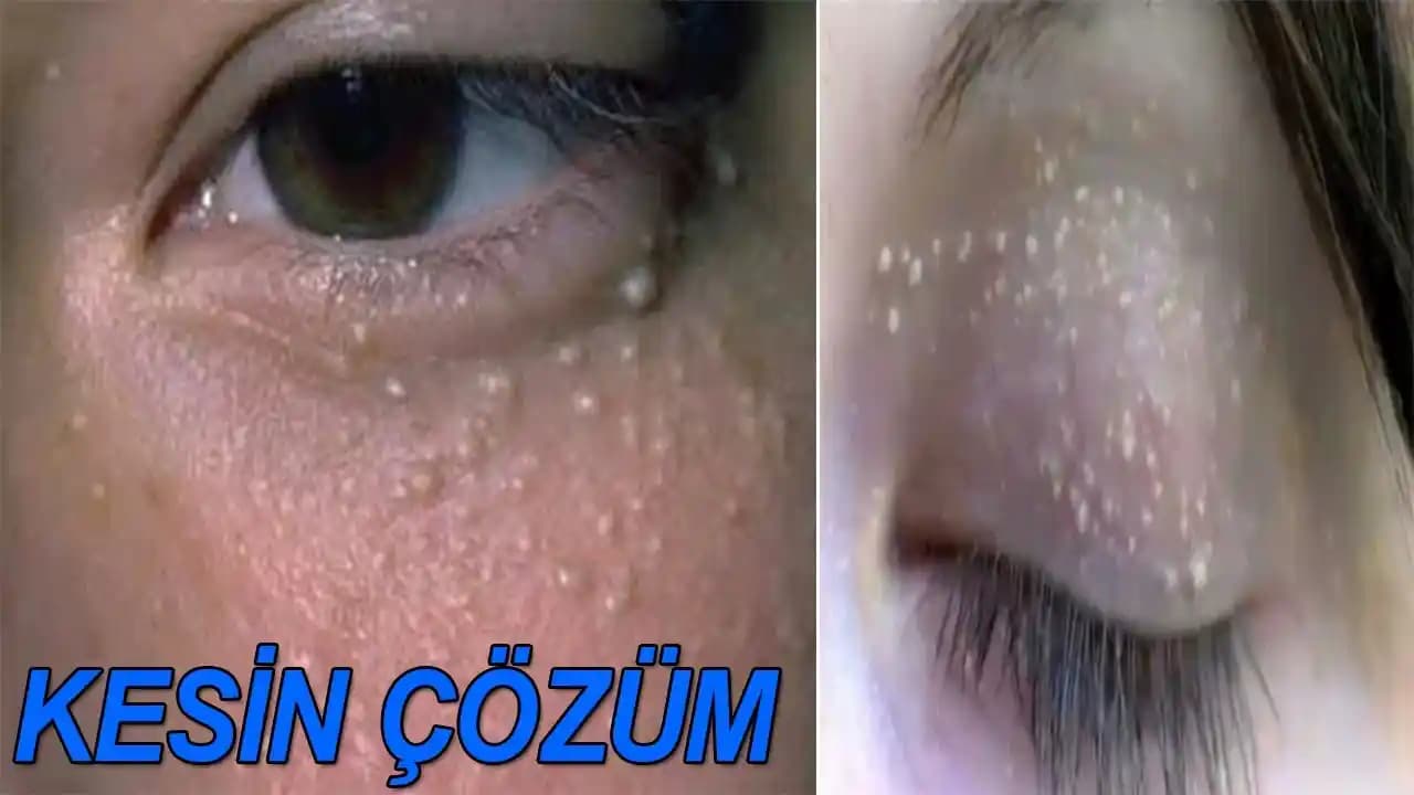 Göz Kapağında Yağ Bezesi: Nedenleri, Belirtileri ve Etkili Tedavi Yöntemleri