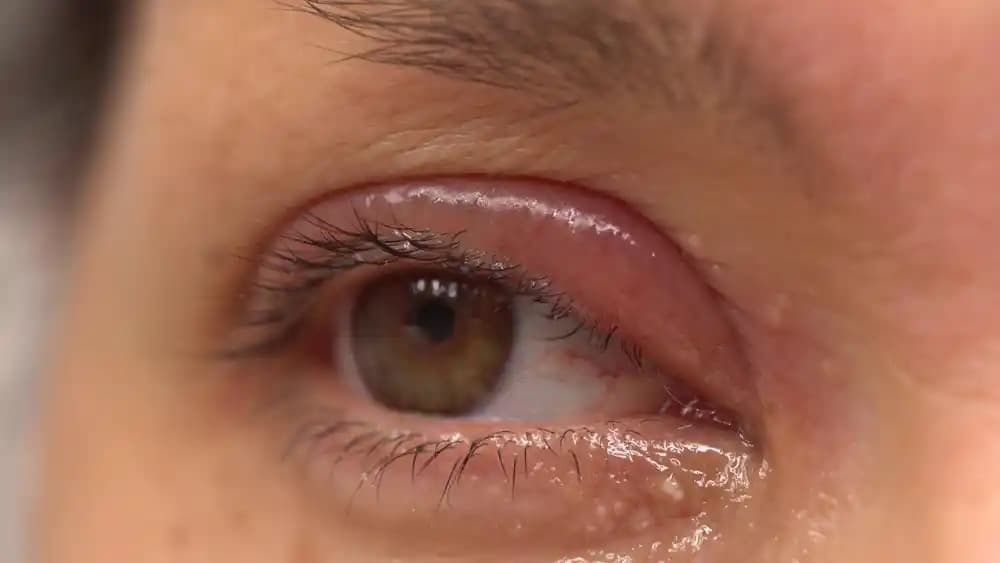 Göz Kapağında Yağ Bezesi Nedenleri ve Korunma Yöntemleri Hakkında Bilgi