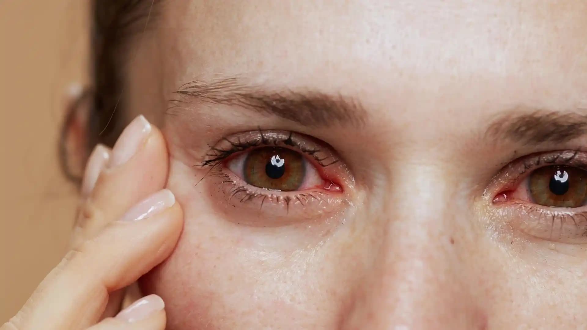 Gözde Egzama Nedenleri ve Tedavi Yöntemleri: Dermatolojik Bir İnceleme