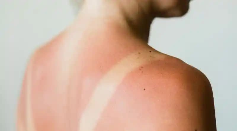 Güneş Yanığından Sonra Kaşıntının Nedenleri ve Etkili Rahatlatma Yöntemleri