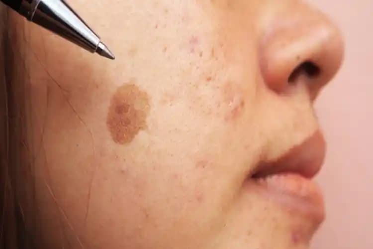 Kahverengi Sivilce Lekeleri: Oluşumu, Nedenleri ve Etkili Cilt Bakım Yöntemleri