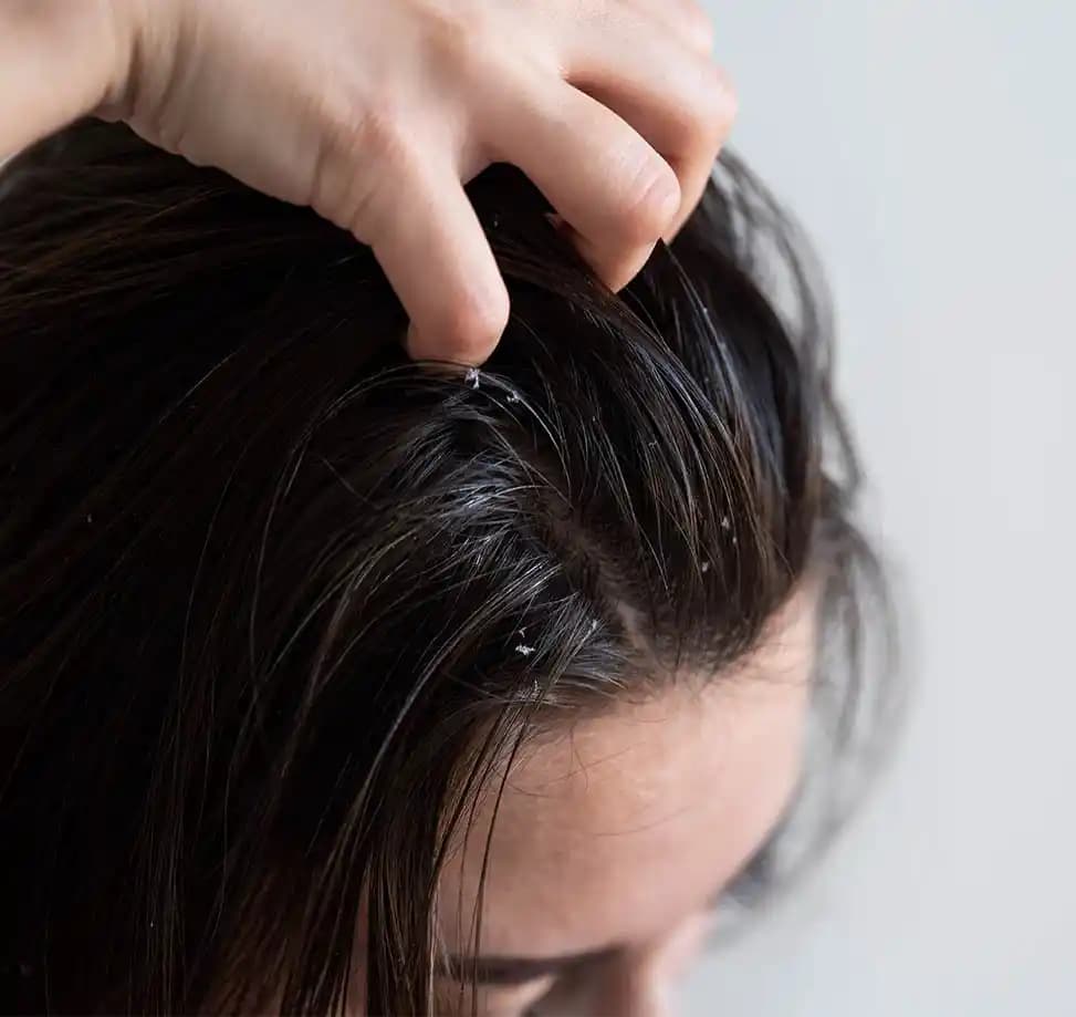 Saç Mantarı Nedir ve Nasıl Tedavi Edilir? Etkili Yöntemler ve Belirtiler