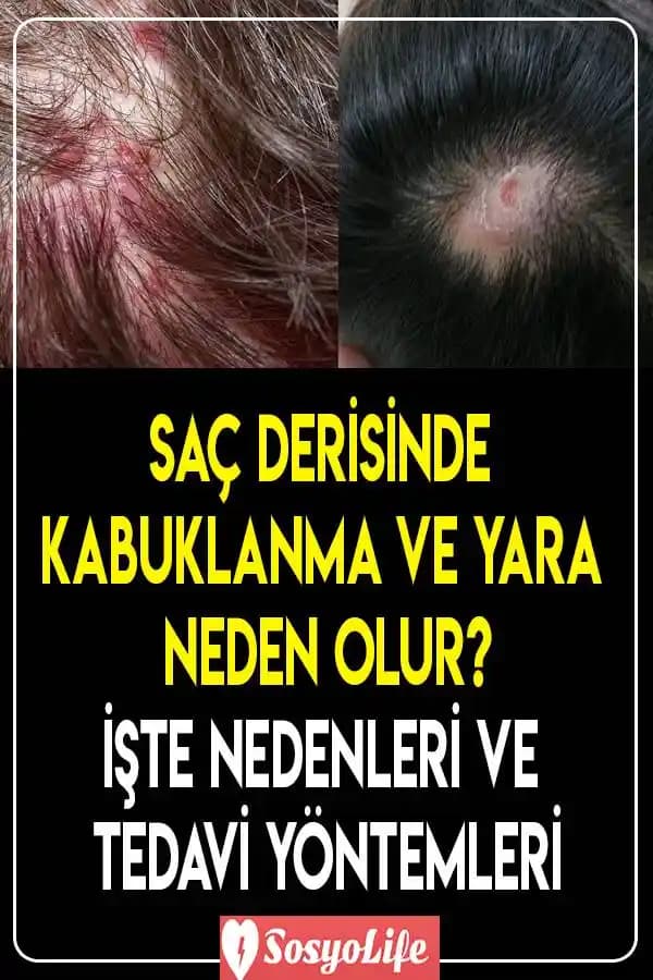 Saçta Yara Oluşumunun Nedenleri ve Saç Derisi Sağlığına İlişkin Temel Bilgiler