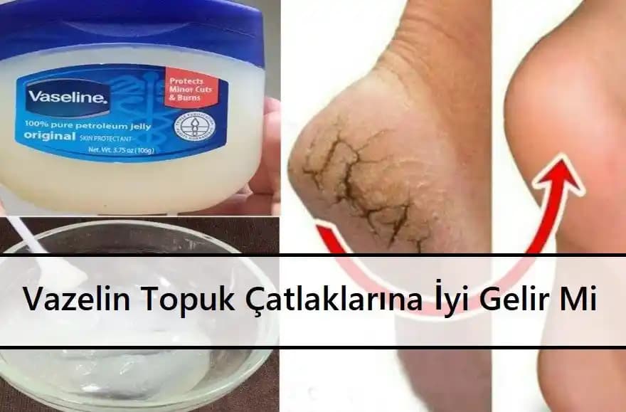 Vazelin ve Topuk Çatlakları: Mevcut Bilgi Durumu ve Etkileri Üzerine Değerlendirme