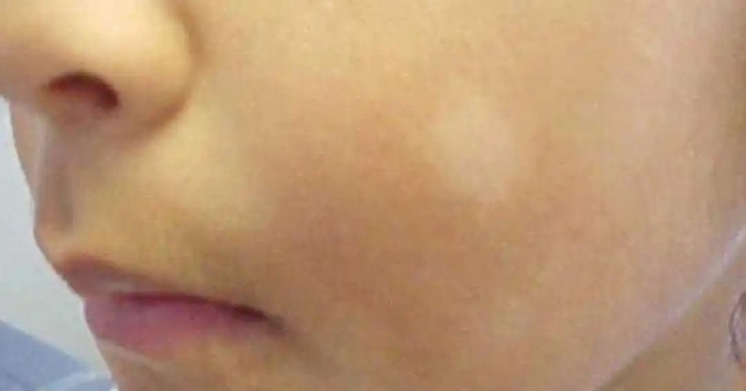 Yüzde Çıkan Beyaz Lekeler: Nedenleri, Cilt Bakımı ve Tedavi Yaklaşımları