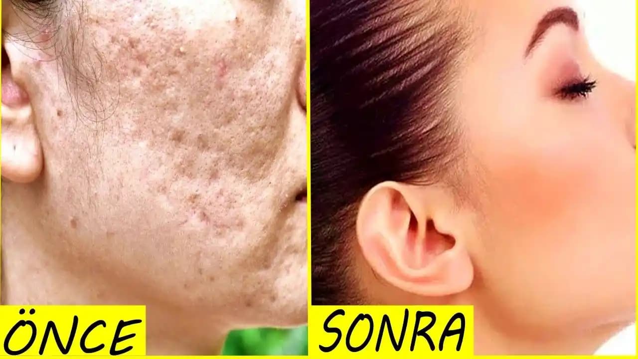 Yüzdeki Çukurların Nedenleri ve Tedavi Yöntemleri: Dermatolojik ve Kozmetik Yaklaşımlar