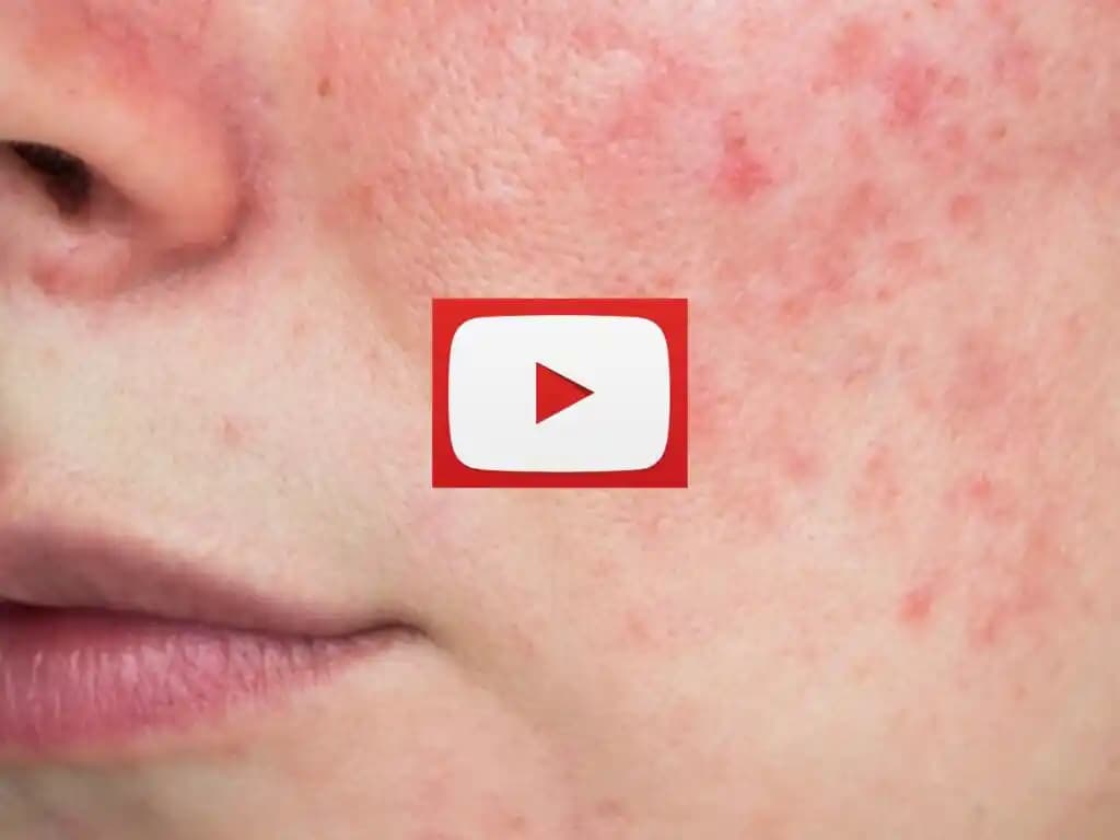 Yüzün Kızarması Nedenleri ve Mevcut Bilgi Eksikliği Üzerine Genel Değerlendirme