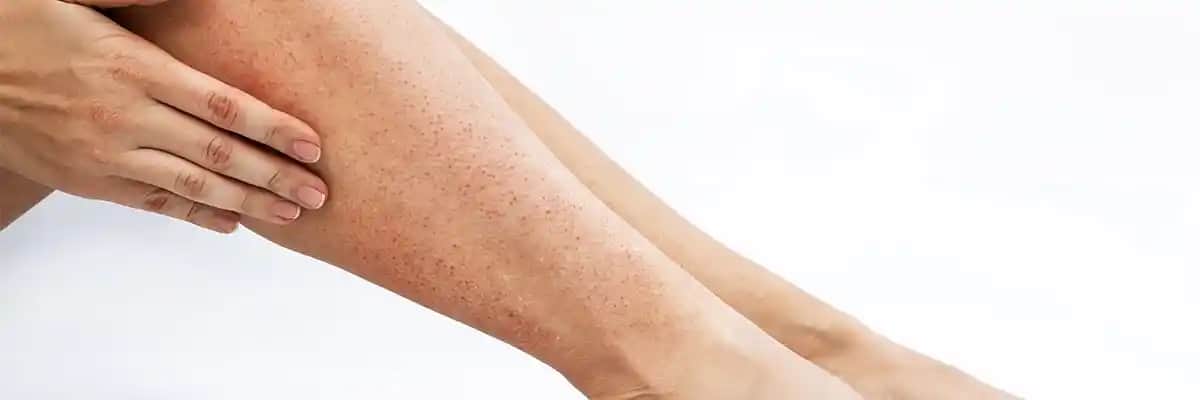 Ağda Sonrası Kızarıklık Nedenleri ve Etkili Çözüm Yolları