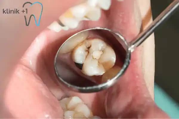 Ağız İçi Siyah Lekelerin Nedenleri, Tanısı ve Tedavi Yöntemleri