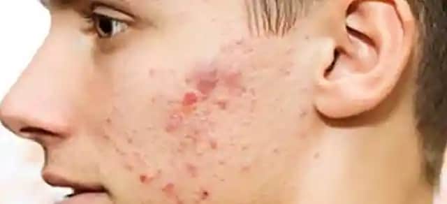 Akneli Ciltler İçin Doğru Bakım Yöntemleri ve Etkili Ürün Seçimleri