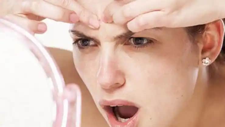 Akneye Ne İyi Gelir? Doğal ve Etkili Yöntemlerle Cilt Sağlığını Destekleme