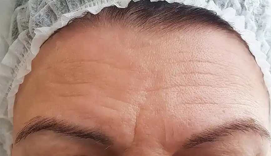 Alın Kırışıklıkları ve Etkili Krem Seçenekleri: Doğru Bakımla Gözle Görülür Sonuçlar