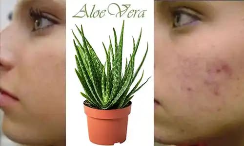 Aloe Vera ve Sivilce: Doğal Çözümlerle Cilt Sağlığını Destekleme Rehberi