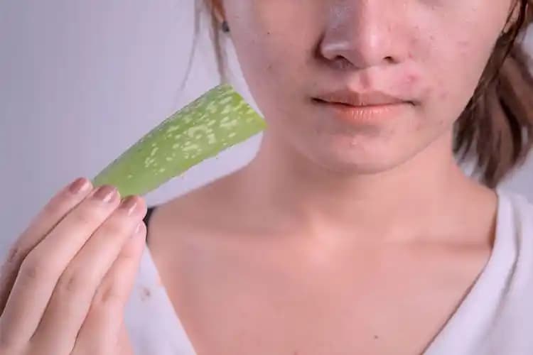 Aloe Vera ve Sivilce: Doğru Kullanım ve Yanlış Anlamalar Hakkında Bilmeniz Gerekenler