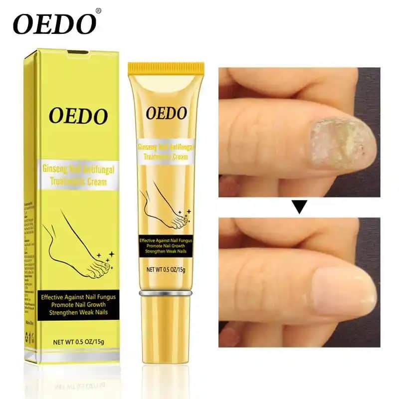 Antifungal Tırnak Kremleri ve Mantar Enfeksiyonlarına Karşı Etkili Çözümler