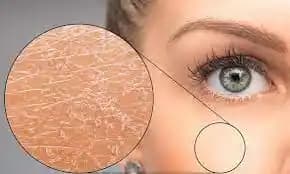 Aşırı Kuru Ciltler İçin Etkili ve Doğal Bakım Yöntemleri Rehberi