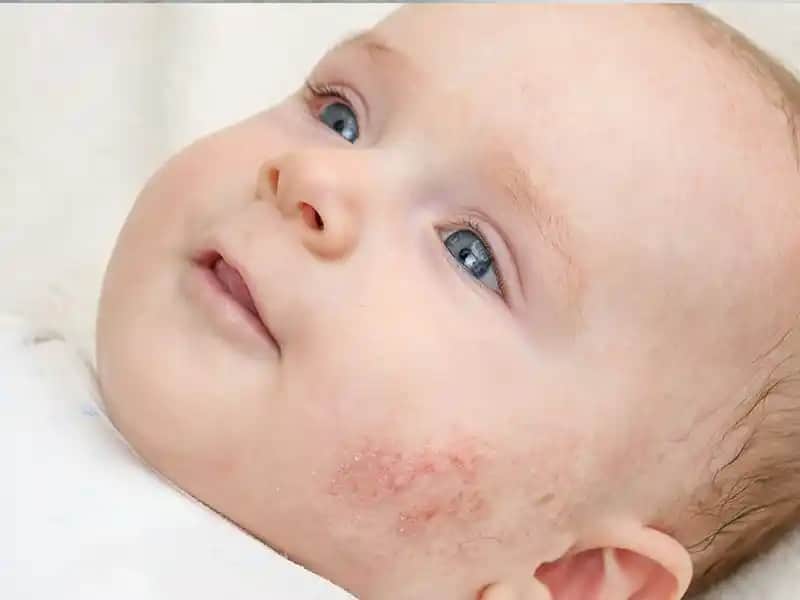 Atopi Eğilimli Cilt Nedir ve Kozmetik Bakım İçin Öneriler