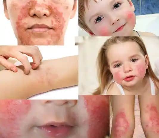 Atopik dermatit tedavisi ve kozmetik ürünler: semptomlar, bakım ve öneriler