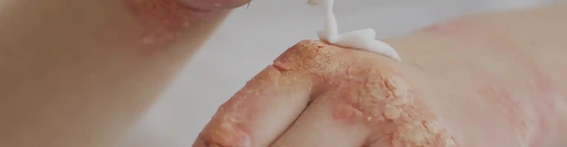 Atopik Dermatite İyi Gelen Yöntemler ve Cilt Sağlığını Güçlendiren Yaklaşımlar