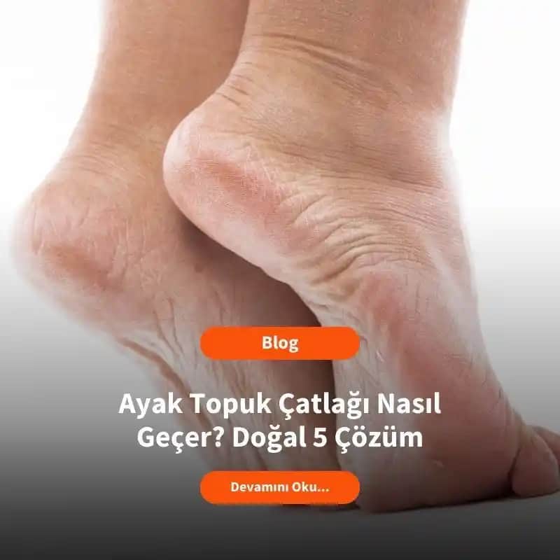 Ayak Çatlaklarının Nedenleri ve Etkili Tedavi Yöntemleri Hakkında Detaylı Bilgi