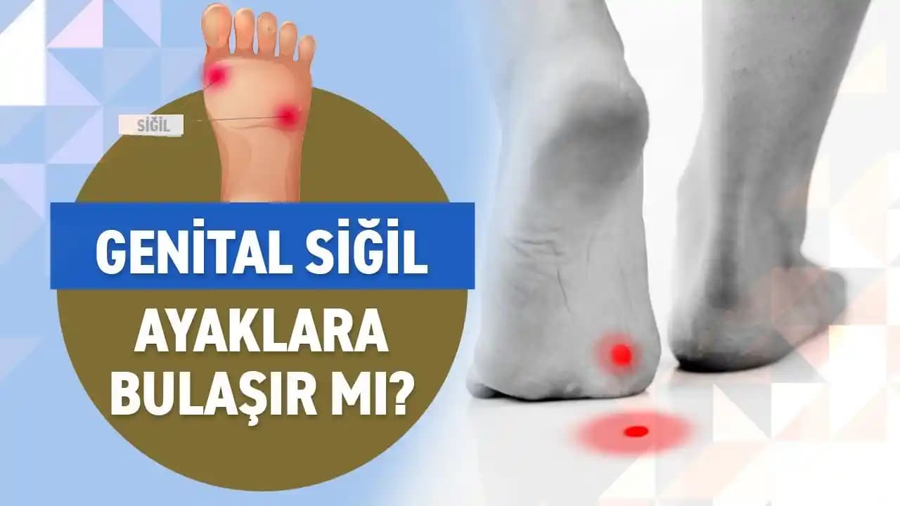 Ayak Parmaklarındaki Sivilceler: Nedenleri, Belirtileri ve Etkili Tedavi Yöntemleri