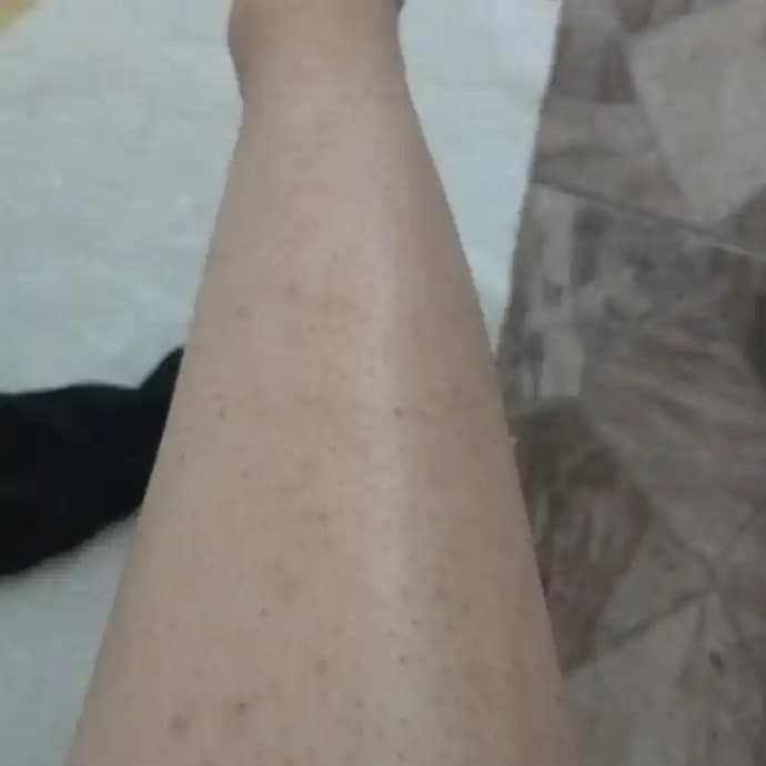 Bacaklardaki Lekeler ve Çözüm Yolları: Kozmetik Perspektiften Kapsamlı Rehber