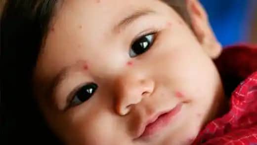 Bebeklerde Ateş Sonrası Vücutta Kızarıklık Nedenleri ve Tedavi Yöntemleri