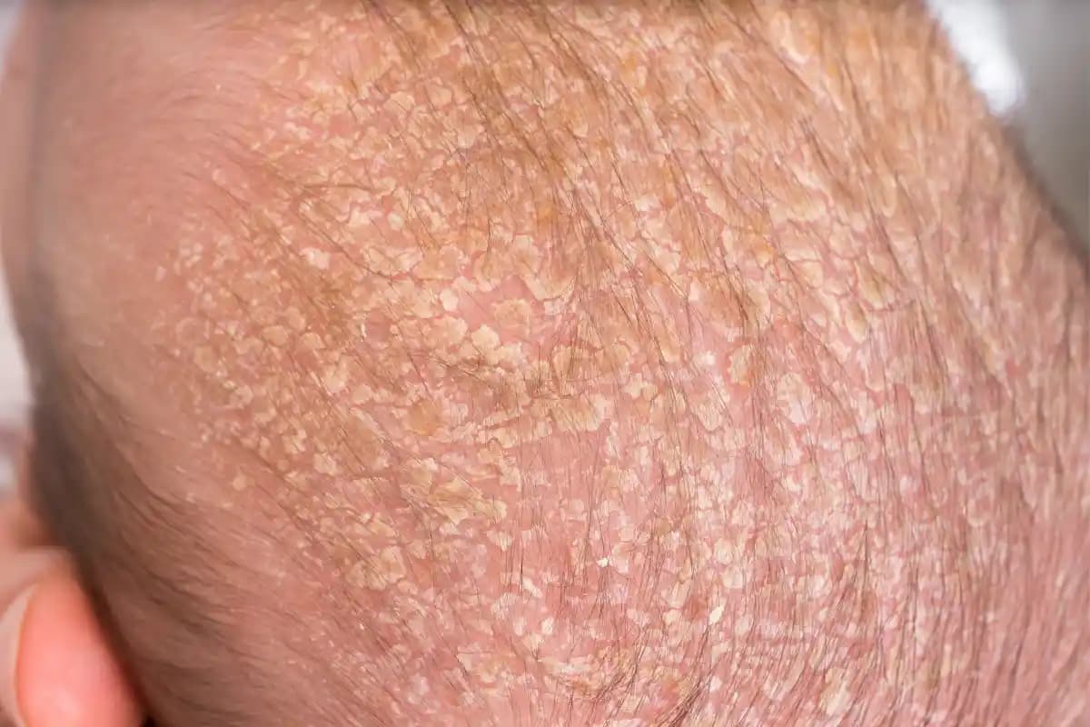 Bebeklerde Kepek Nedenleri ve Güvenli Tedavi Yöntemleri Hakkında Kapsamlı Rehber