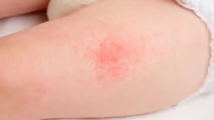 Bebeklerde Pişik Sorunu ve Doğal Çözüm Yöntemleri Hakkında Bilmeniz Gerekenler