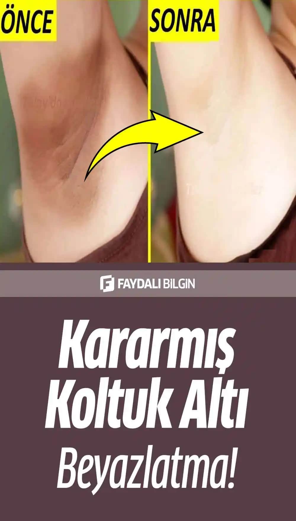 Bikini Bölgesi ve Koltuk Altı Kararması Nedenleri ve Etkili Çözüm Yolları