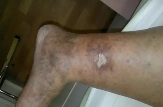 Ayak Lekeleri Nedenleri, Tedavi Yöntemleri ve Korunma İpuçları