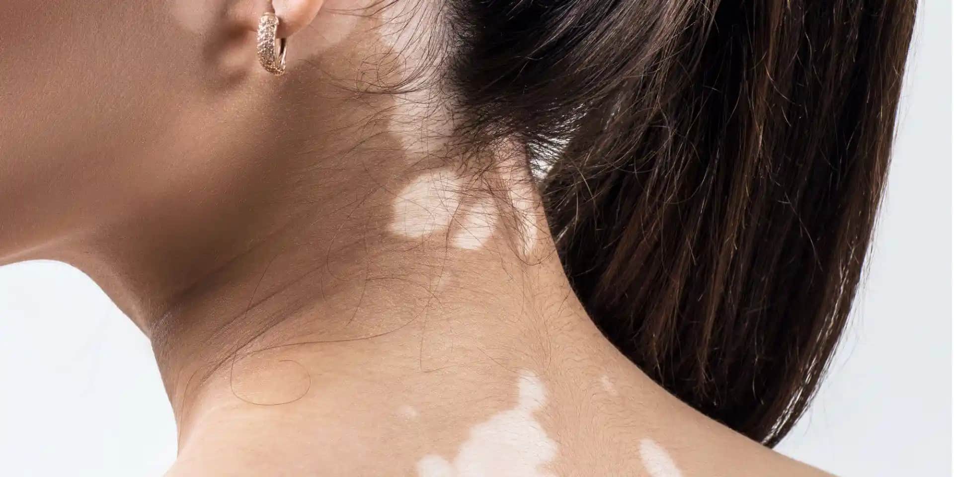 Beyaz Güneş Lekeleri Nedir, Neden Oluşur ve Nasıl Tedavi Edilir