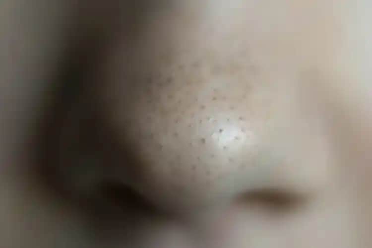 Burundaki Siyah Lekeleri Gidermenin Etkili ve Güvenli Yöntemleri