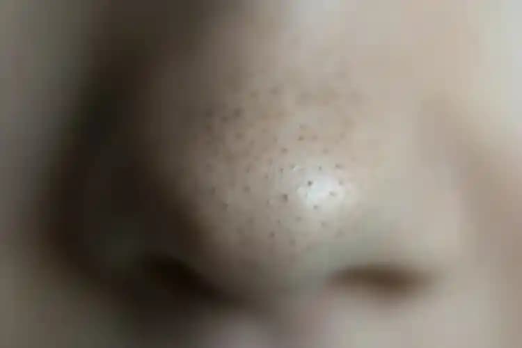 2025'te Burundaki Siyah Lekelerden Kurtulmanın 5 Şaşırtıcı Yolu