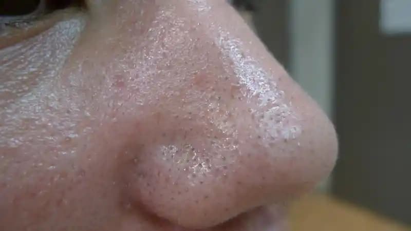 Burundaki Yağlanma Nedenleri ve Doğal Çözüm Yöntemleri Hakkında Bilgiler