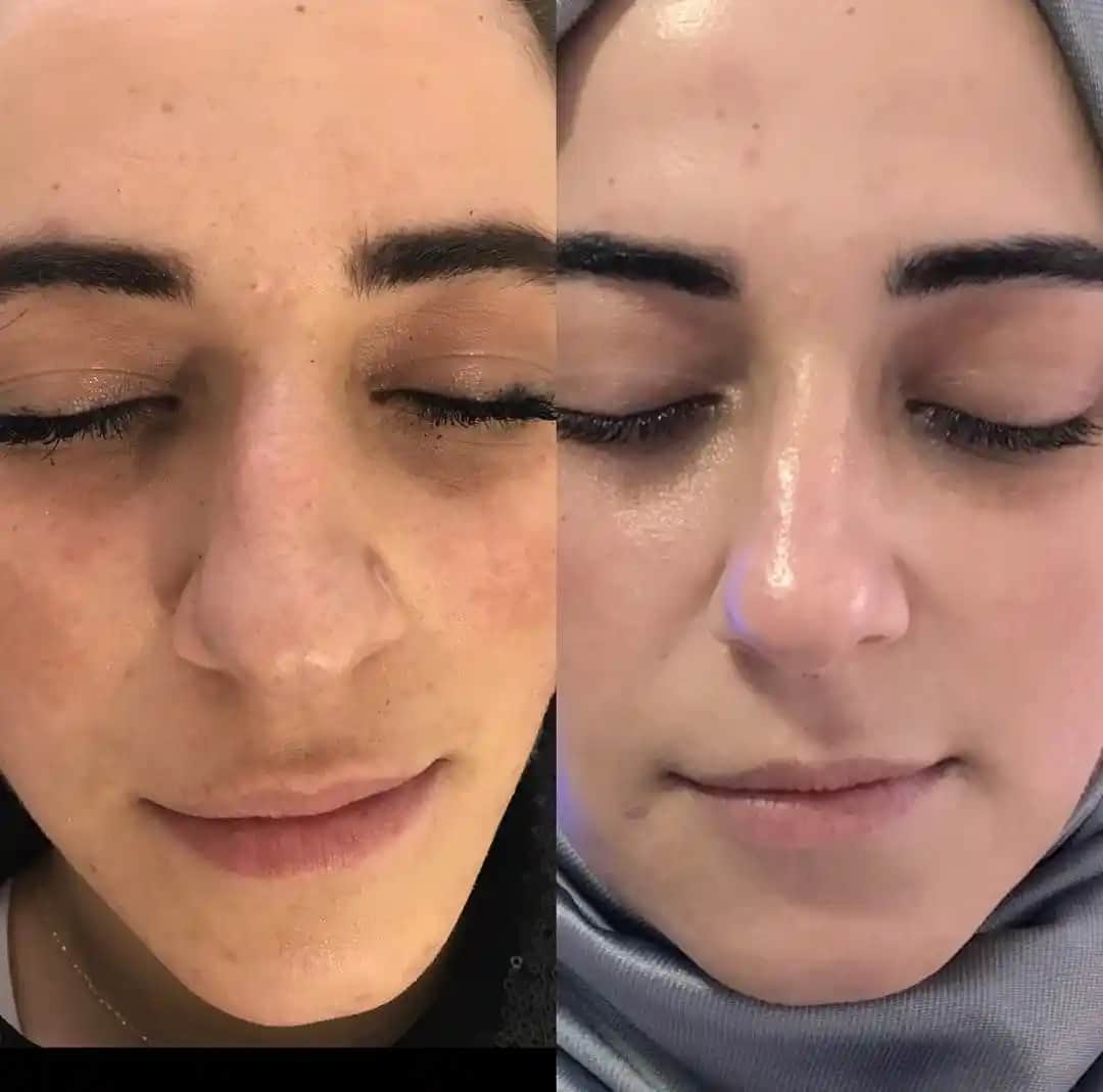 Cilt Gözenek Tedavisi Yöntemleri ve Gelişen Teknolojilerle Etkili Çözümler