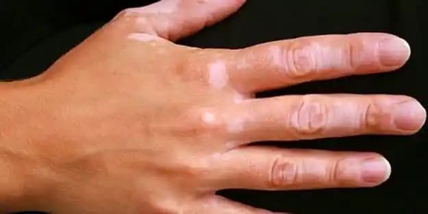 Ciltte Beyaz Leke Nedenleri ve Tedavi Yöntemleri Hakkında Bilmeniz Gerekenler