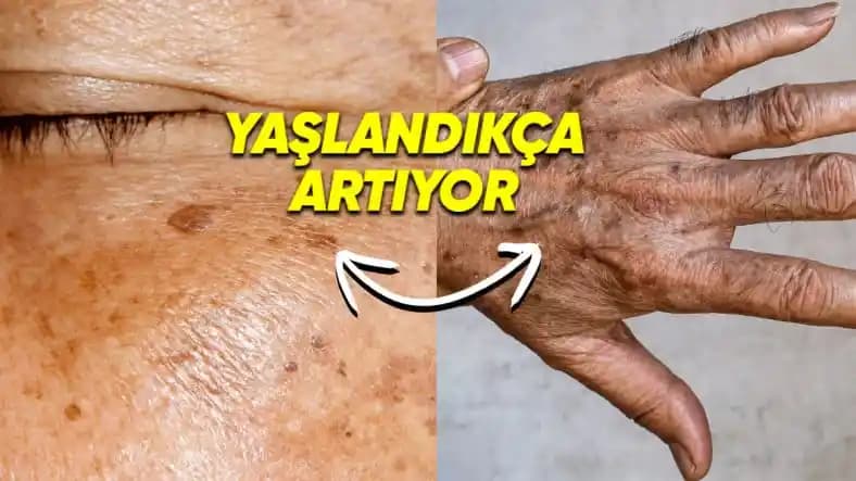 Ciltte Koyu Lekeler: Nedenleri, Tedavi Yöntemleri ve Korunma İpuçları