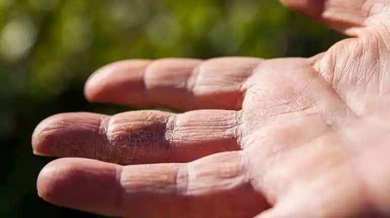 Ciltteki çatlakların nedenleri, önleme ve tedavi yöntemleri hakkında kapsamlı bilgiler