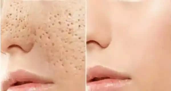 Ciltteki Gözenekleri Temizleme Yöntemleri ve Sağlıklı Cilt İçin İpuçları