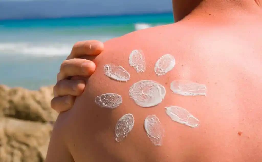 Deniz Yanıklarına Karşı Doğal ve Etkili Çözüm Yöntemleri ve İlk Müdahale Tüyoları