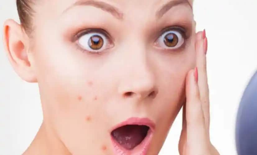 Doktorların Önerdiği Güvenli ve Etkili Sivilce Maskeleriyle Cilt Bakımı Rehberi