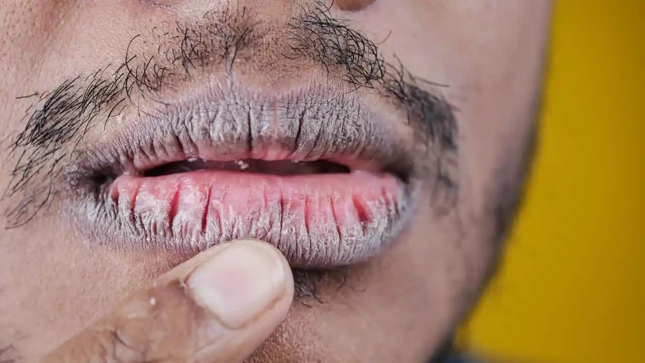 Dudak Çatlaklarına Karşı Etkili Bakım Yöntemleri ve Sağlıklı Dudaklar İçin İpuçları