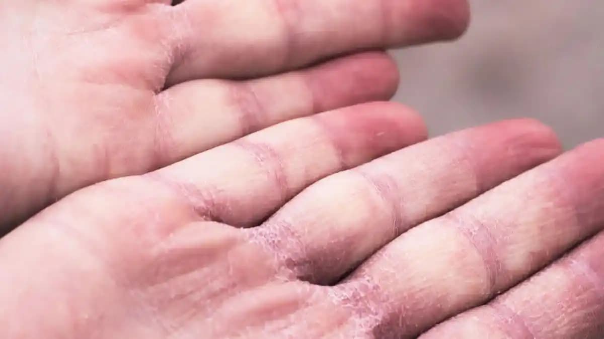 Ellerinizin Çatlamasını Önlemek ve Tedavi Etmek İçin Bilinçli Bakım Rehberi